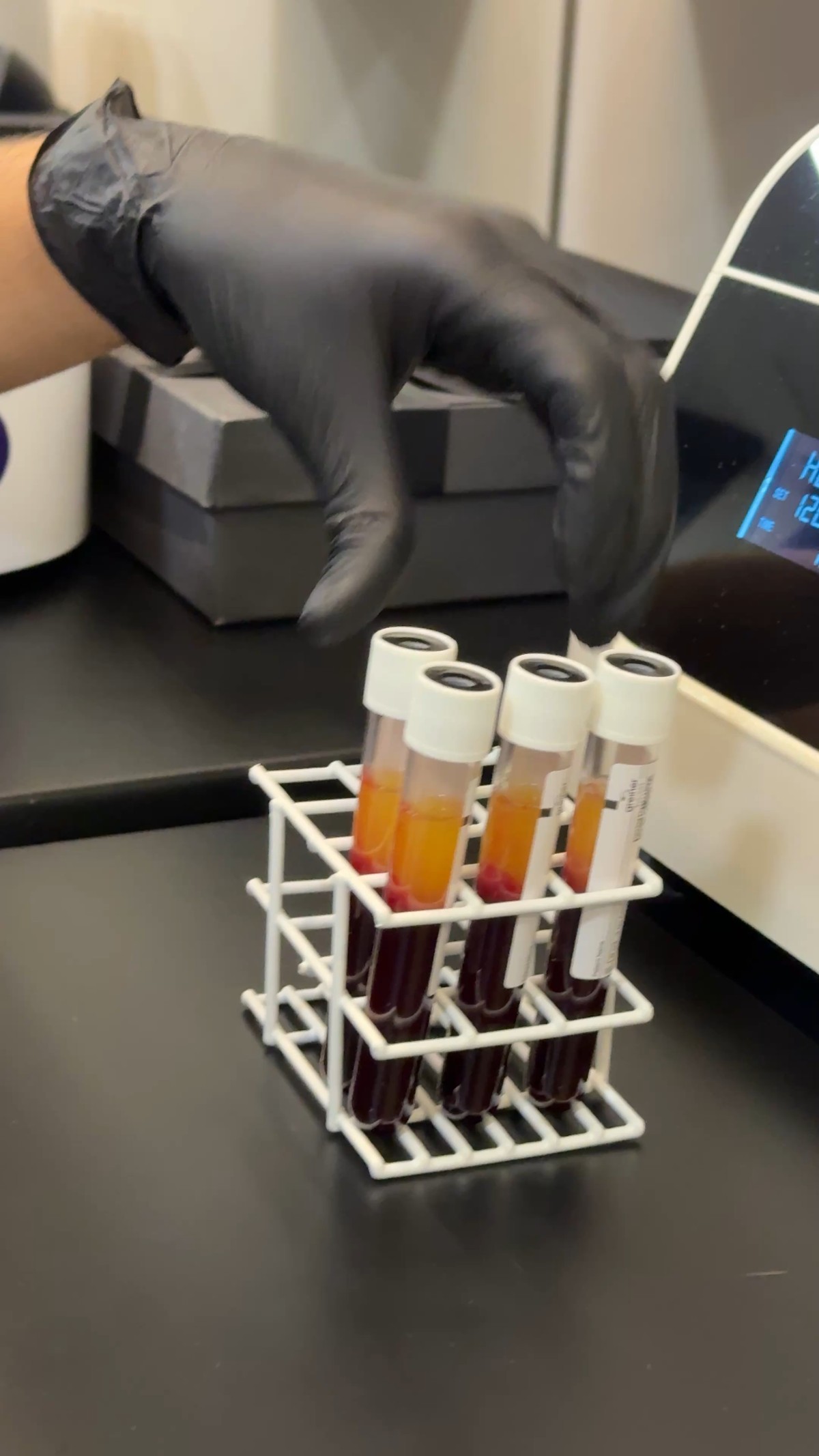Tubos de i-PRF após centrifugação: camada dourada de fibrina rica em plaquetas acima e hemácias vermelhas abaixo. Protocolo real da Clínica Dr. Gustavo Martins, Rio de Janeiro.