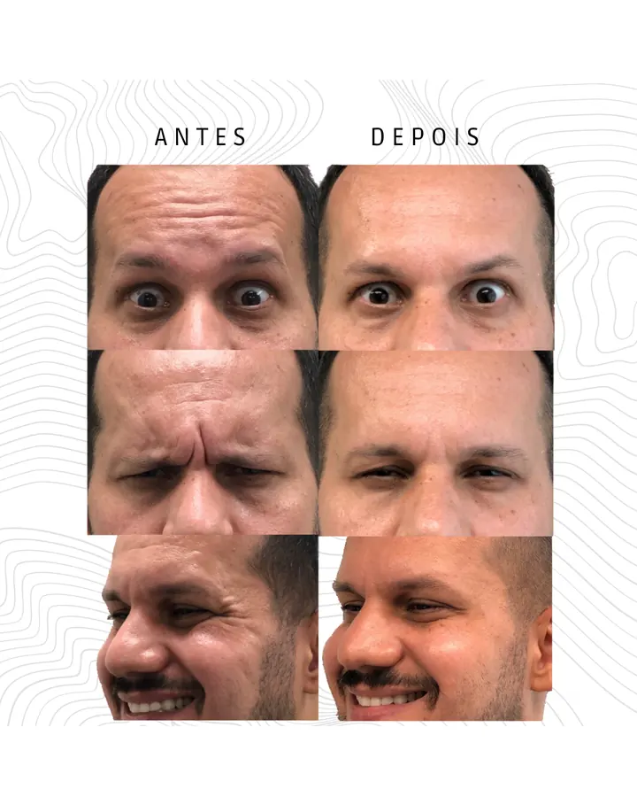 Toxina Botulínica · paciente 1