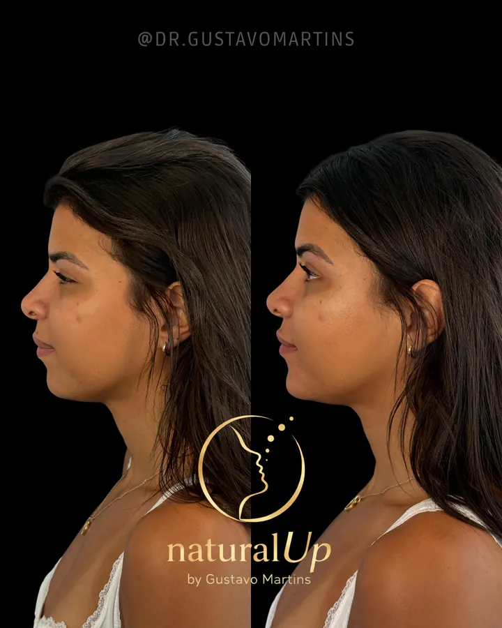 Método NaturalUp® · paciente 2