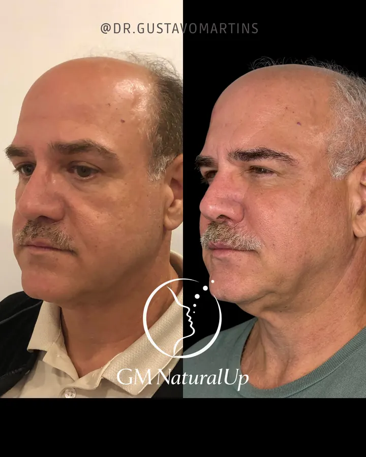 Método NaturalUp® · paciente 3