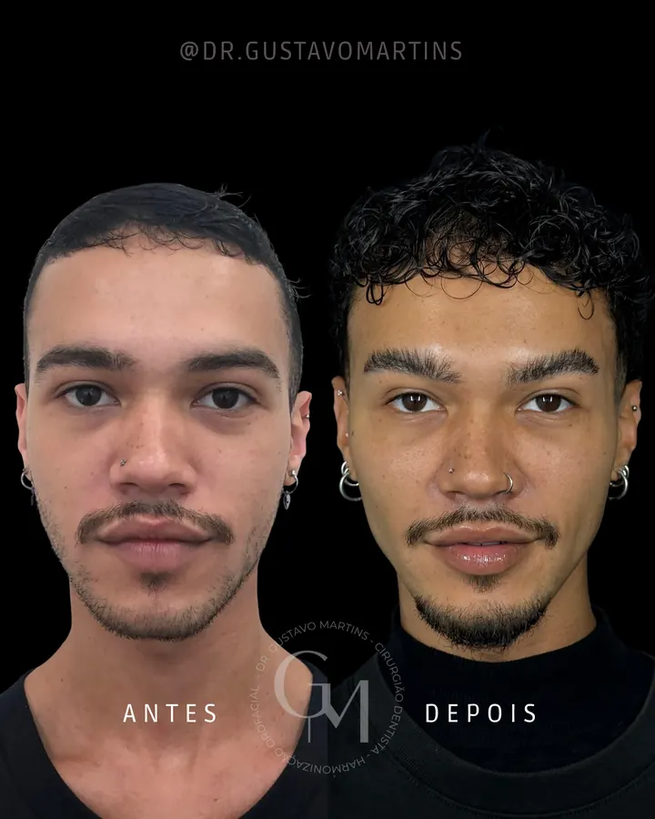 Método NaturalUp® · paciente 4
