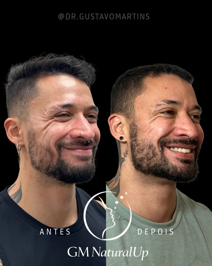 Método NaturalUp® · paciente 5
