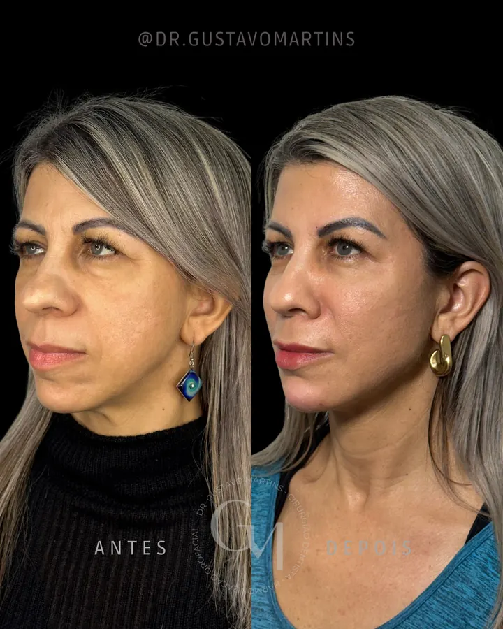 Método NaturalUp® · paciente 10