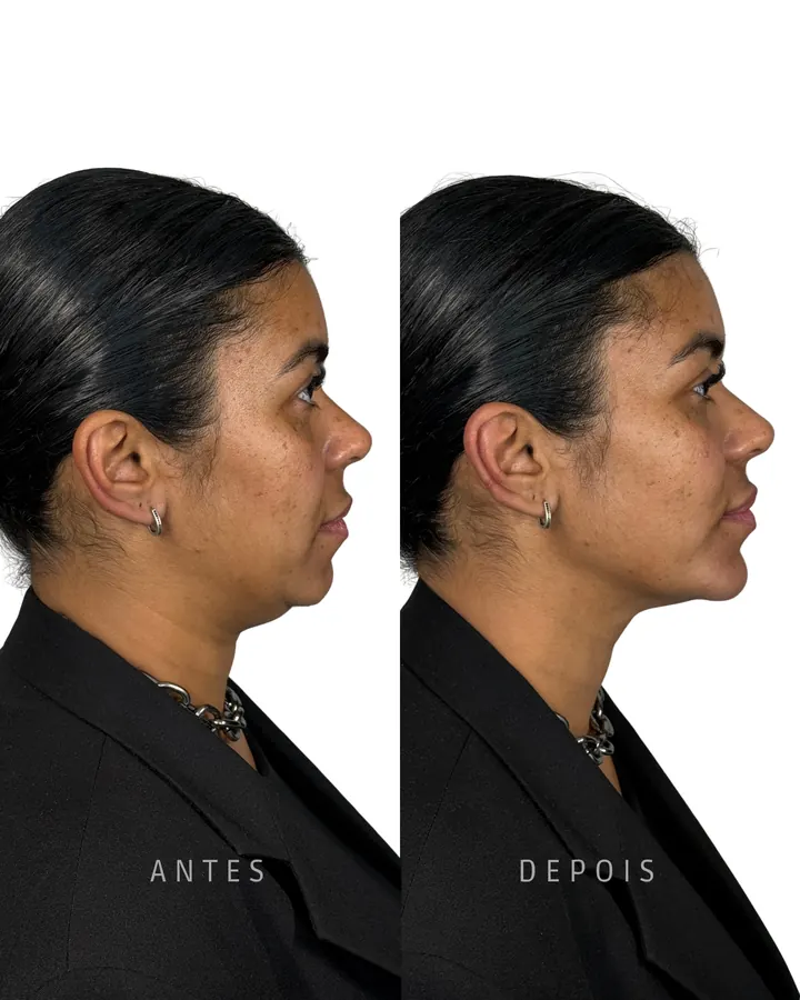 Método NaturalUp® · paciente 13