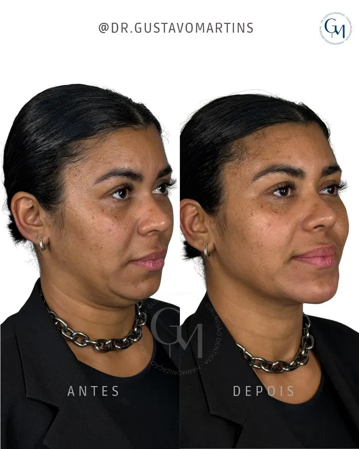 Método NaturalUp® · paciente 14