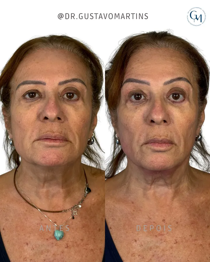 Método NaturalUp® · paciente 15
