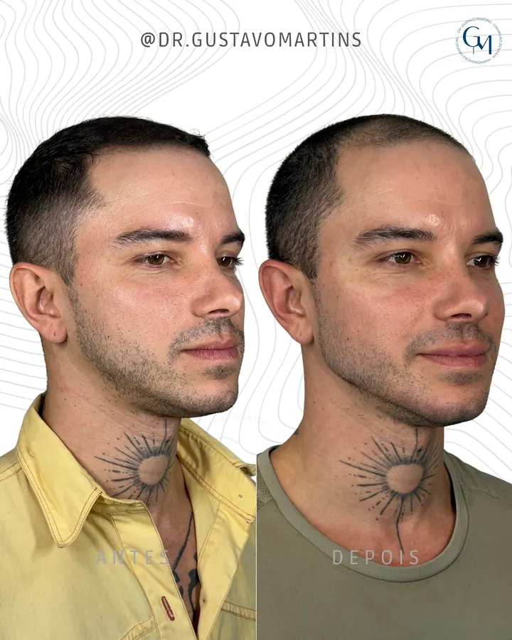 Método NaturalUp® · paciente 17