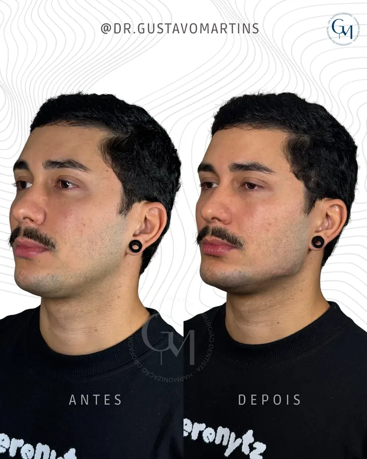 Método NaturalUp® · paciente 18