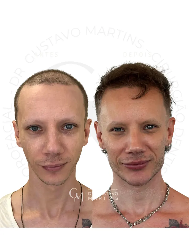 Método NaturalUp® · paciente 20