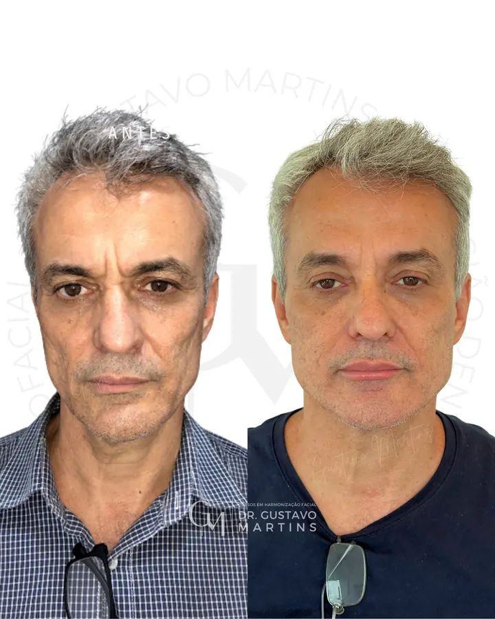 Método NaturalUp® · paciente 21