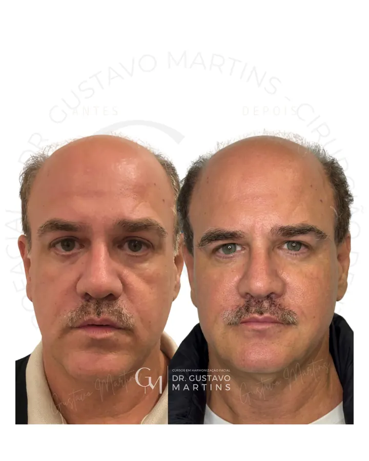 Método NaturalUp® · paciente 22