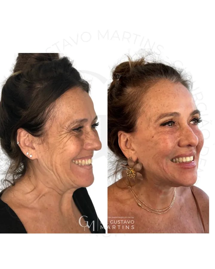 Método NaturalUp® · paciente 23