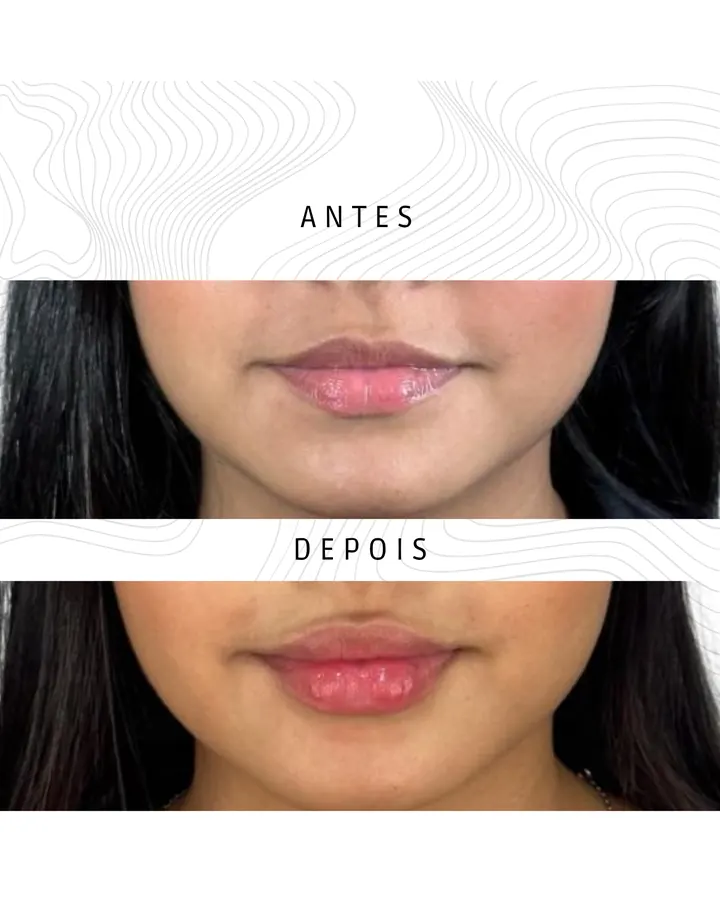 Preenchimento Labial · paciente 1