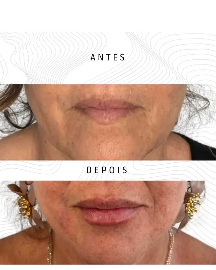 Preenchimento Labial · paciente 2