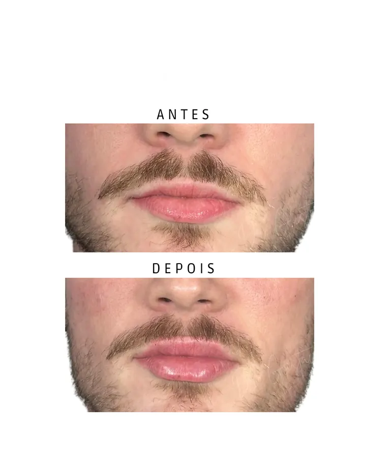 Preenchimento Labial · paciente 3