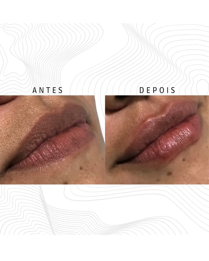 Preenchimento Labial · paciente 4
