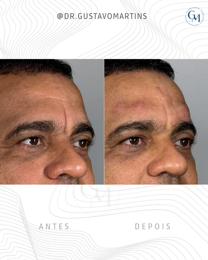 Tratamento de Olheiras · paciente 2