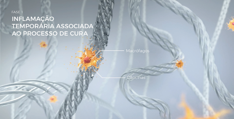 Fase 1 do processo regenerativo do Ultherapy, inflamação temporária com macrófagos e citocinas