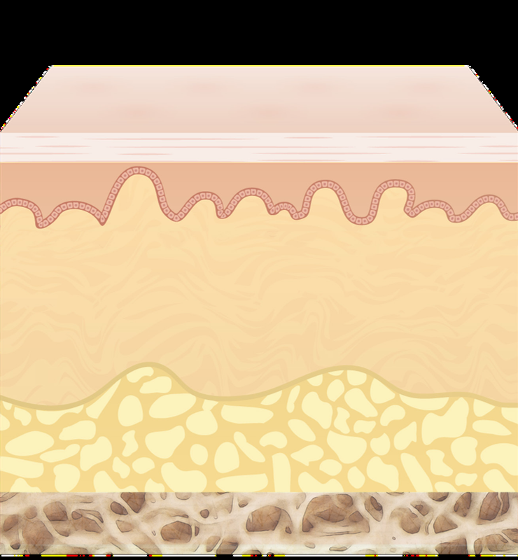 Diagrama das camadas da pele tratadas pelo Ultherapy: 1,5mm, 3,0mm e 4,5mm