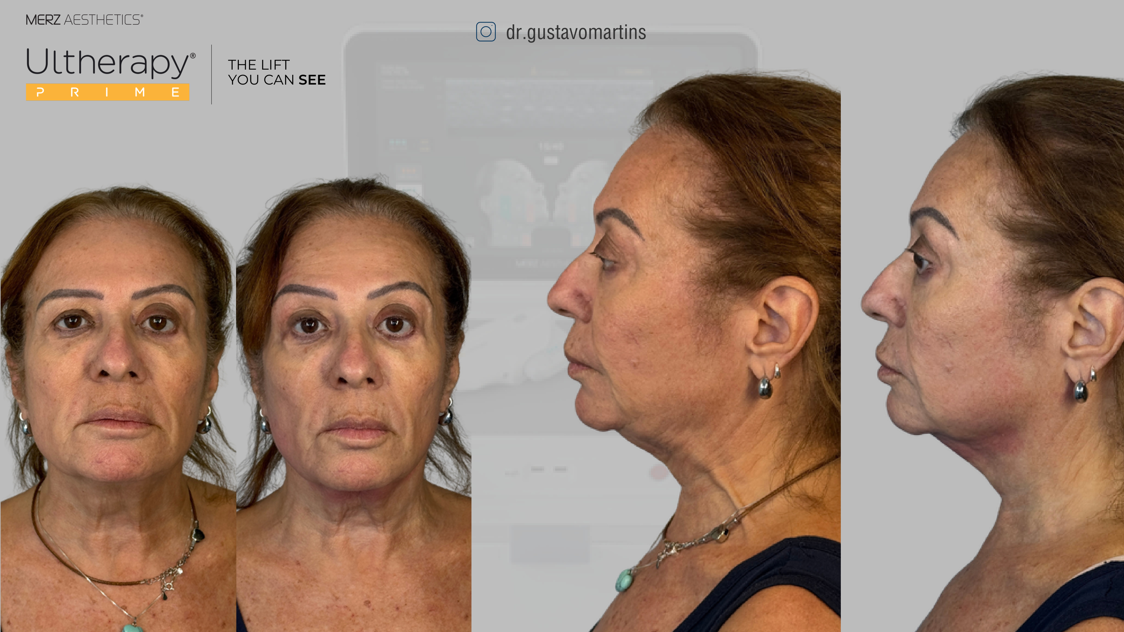 Antes e depois Ultherapy, frente e perfil, paciente real do Dr. Gustavo Martins
